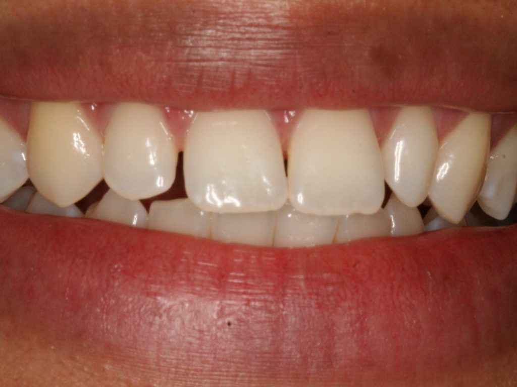 Changing the Size and Shape of Teeth with Veneers PureCare Dental