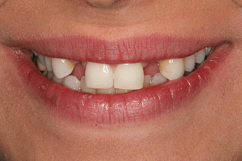front teeth implants before