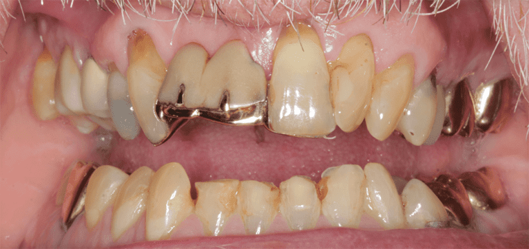 using-a-dental-bridge-to-replace-front-missing-teeth-purecare-dental