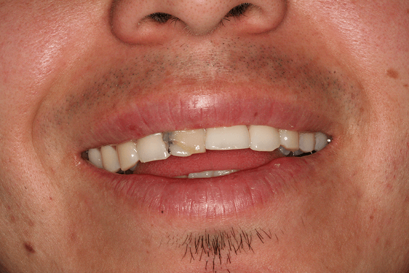 front tooth implant before