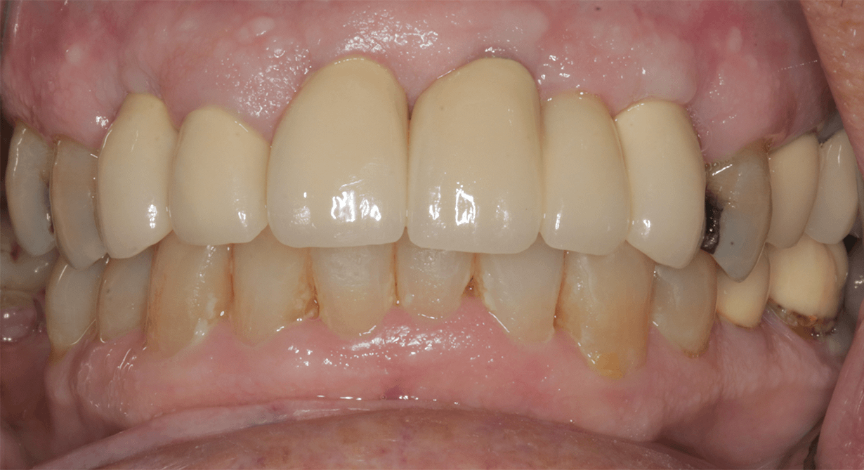 Central Oregon Dental Implant After