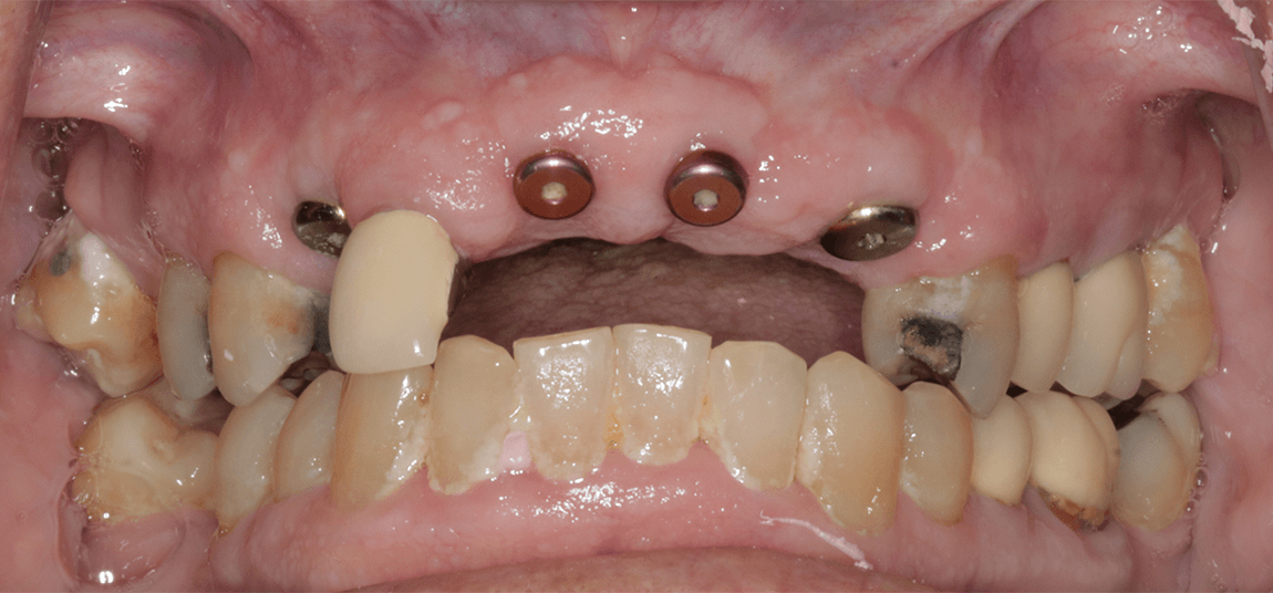 Central Oregon Dental Implant Before