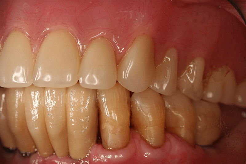 lower teeth implants after
