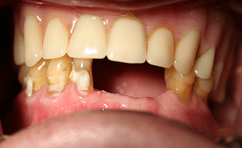 lower teeth implants before