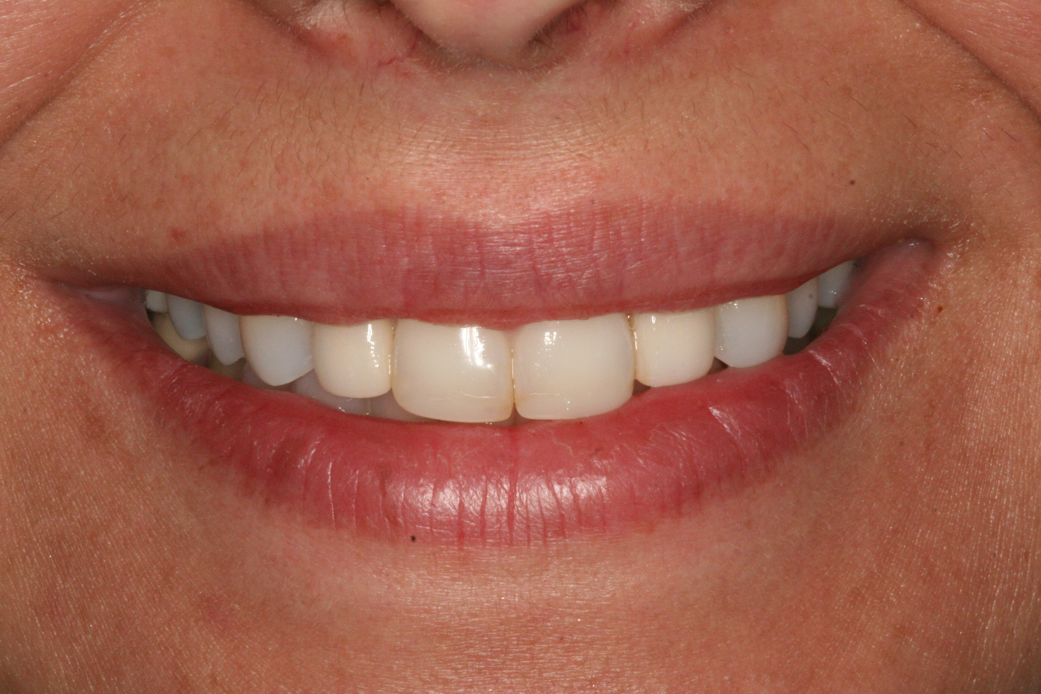 front teeth implants after