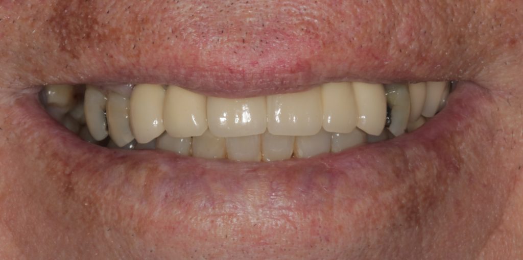 After 6 implants
