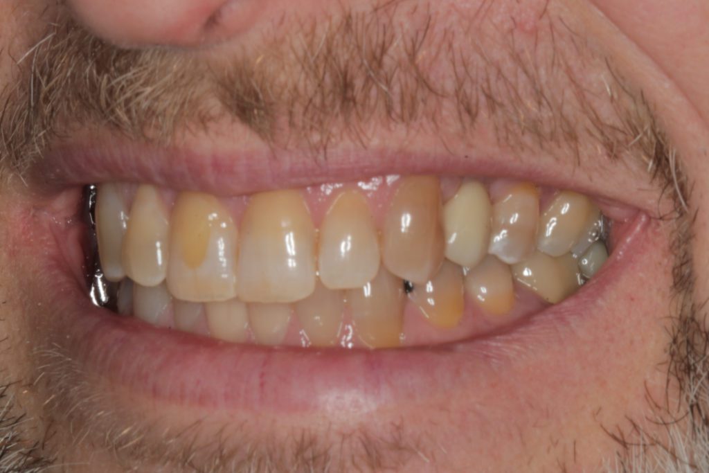 After Implant Placement