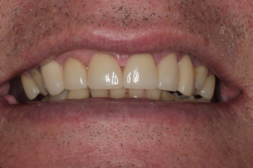 After anterior veneers