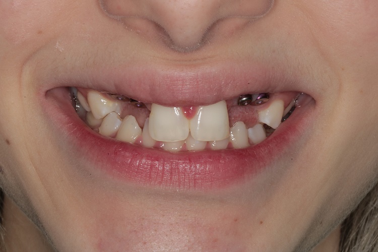 Before anterior implants