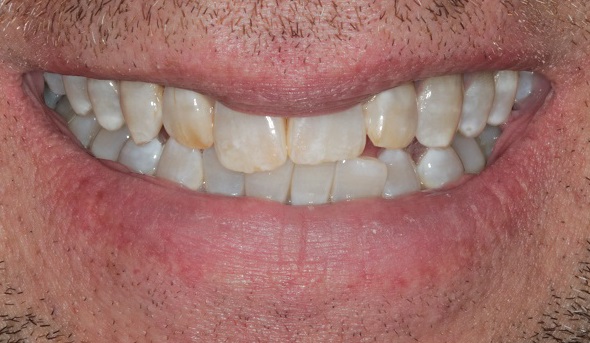 front teeth before