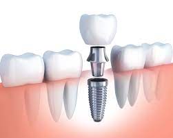 dental implant parts