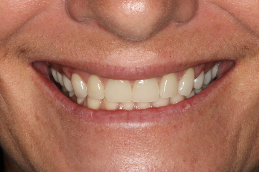 front teeth after crowns