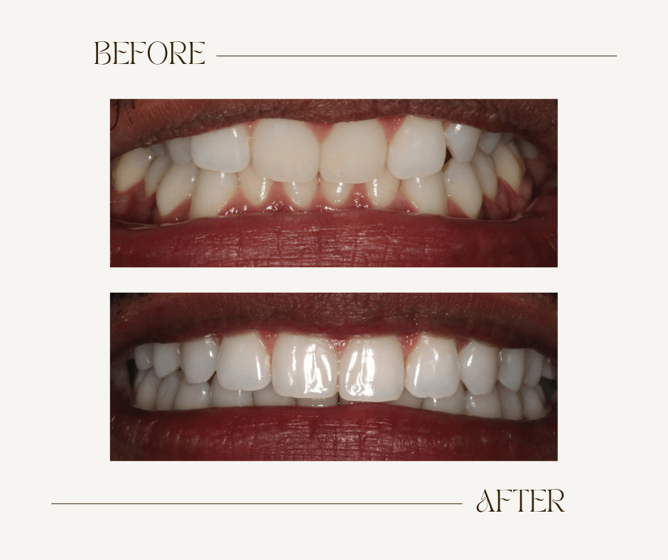 Bryan Before-After Ortho 3