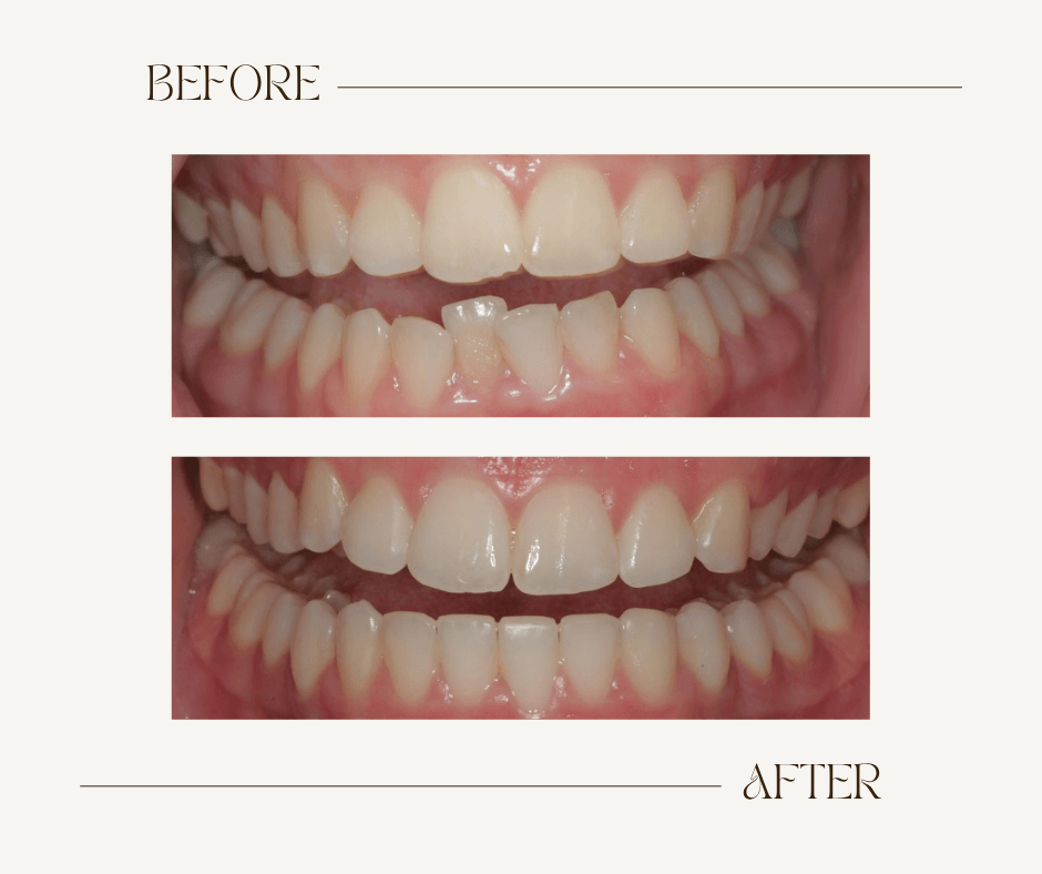 Mikaela Before-After Ortho