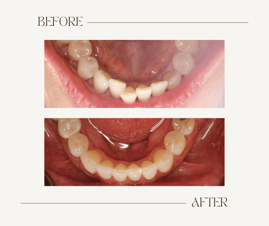 Theresa Before-After Ortho 1